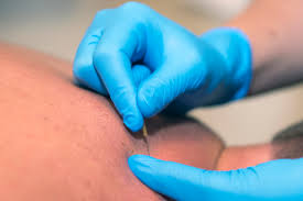 Dry Needling